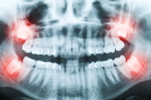 Morte de jovem após retirada do dente siso assusta; especialista de Colatina explica sobre cuidados
