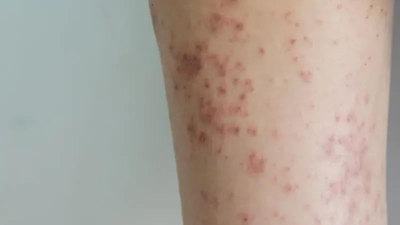 Dois óbitos por Febre Maculosa em Colatina: reveja os casos