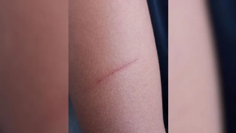 Polícia Civil investiga ferimento de aluno de 11 anos em escola de Colatina