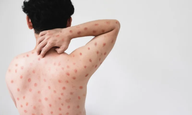 Colatina registra primeiro caso de Mpox em 2026, confirma Sesa