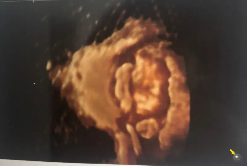 Hospital em Colatina dá diagnóstico de óbito fetal, mas gestante descobre que bebê está vivo