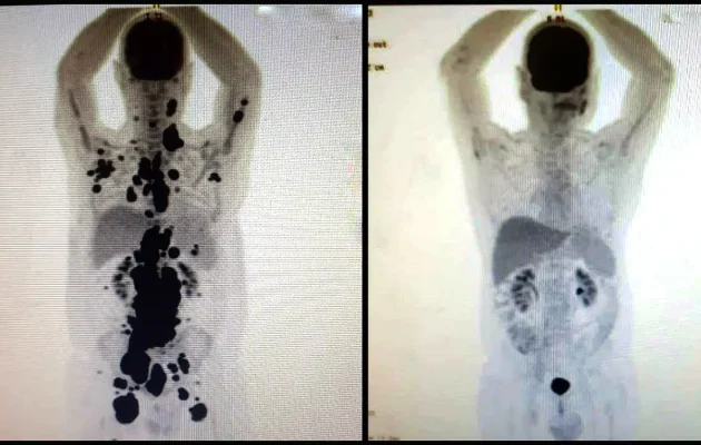 cancer-antes_depois